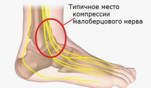 Невралгия или синдром сдавления нерва