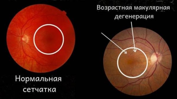 Что такое географическая атрофия, как она влияет на зрение