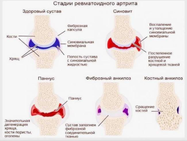 Как справиться с усталостью при ревматоидном артрите