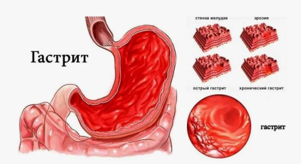 Что такое гастрит