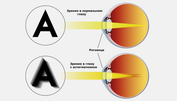 Астигматизм у детей